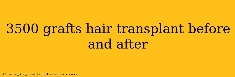 3500 grafts hair transplant before and after