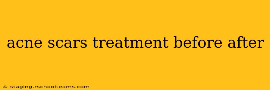 acne scars treatment before after