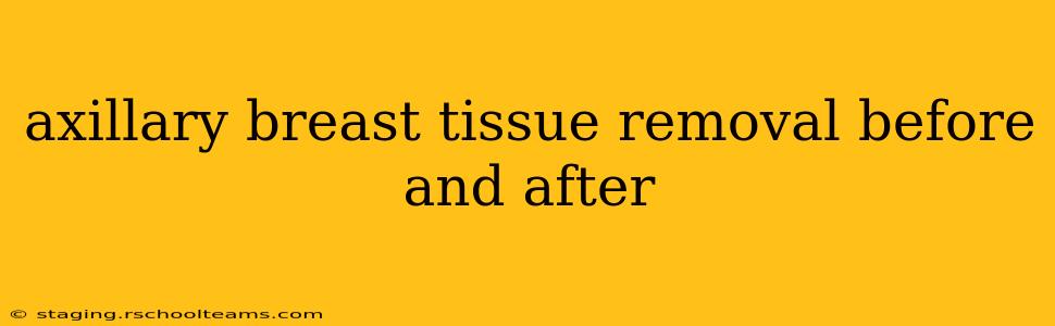 axillary breast tissue removal before and after