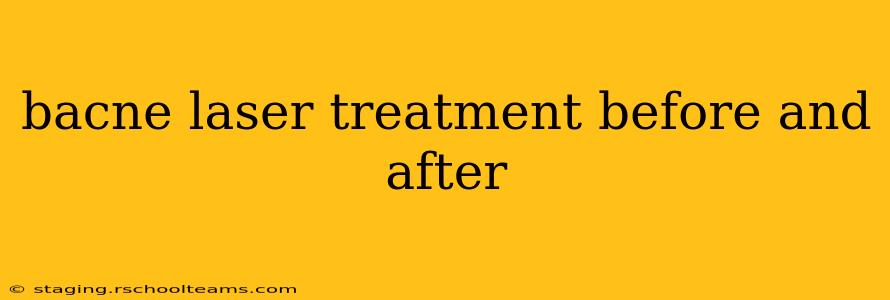 bacne laser treatment before and after