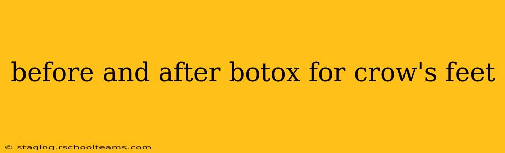 before and after botox for crow's feet