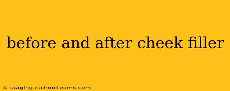 before and after cheek filler