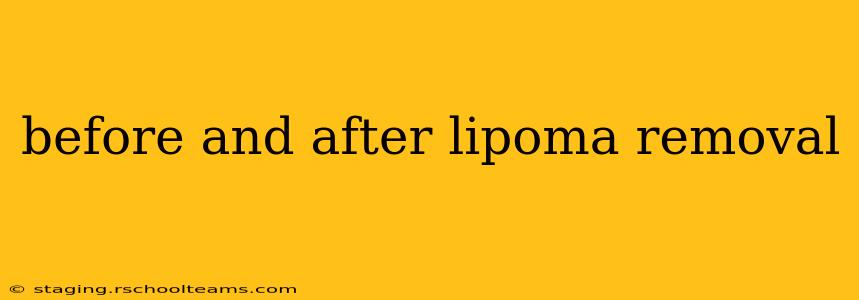 before and after lipoma removal