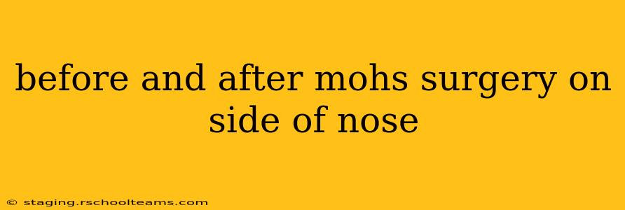 before and after mohs surgery on side of nose