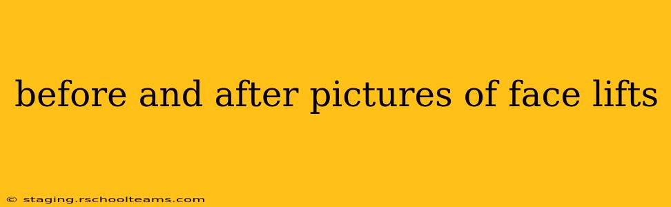 before and after pictures of face lifts