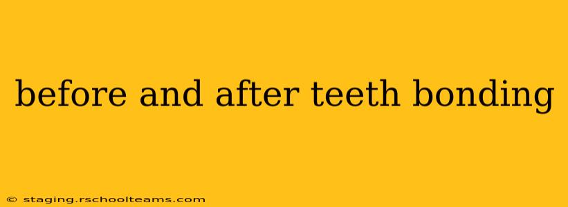 before and after teeth bonding