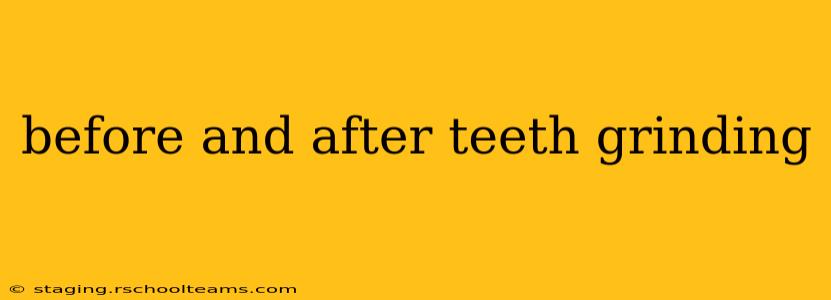 before and after teeth grinding