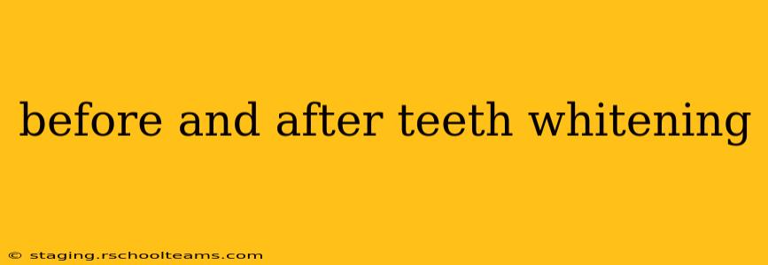 before and after teeth whitening