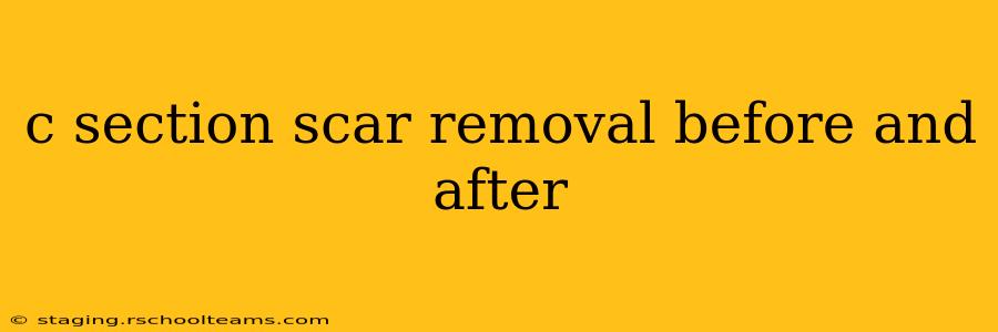 c section scar removal before and after