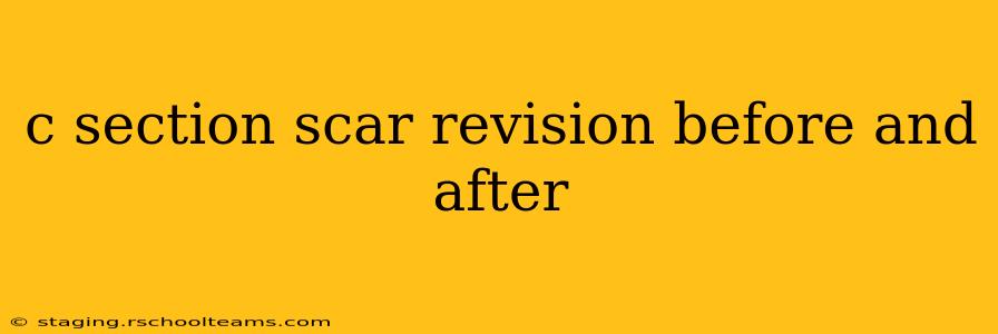 c section scar revision before and after