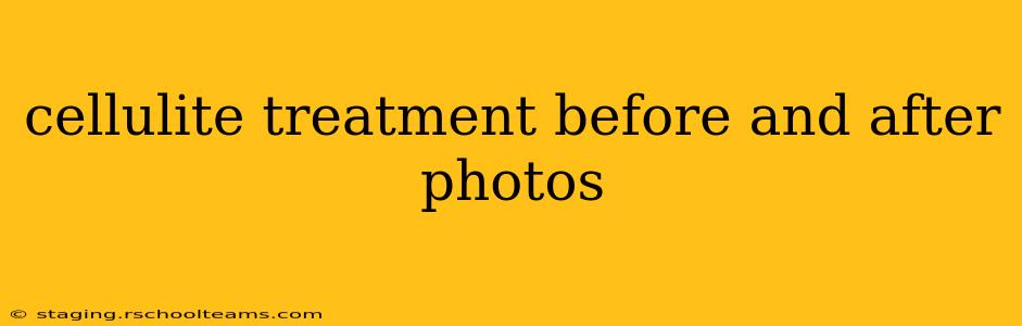cellulite treatment before and after photos