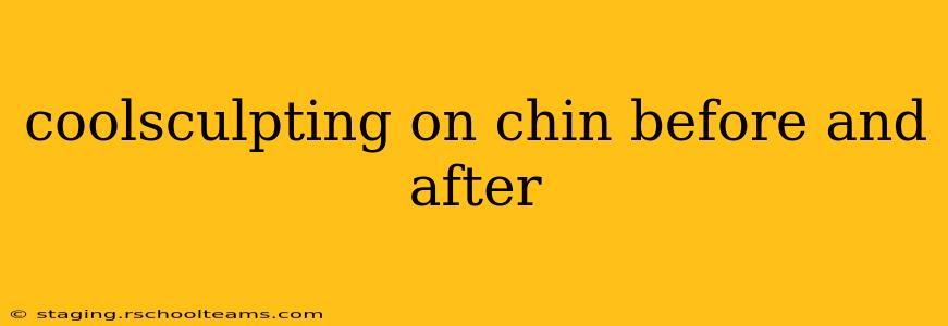 coolsculpting on chin before and after