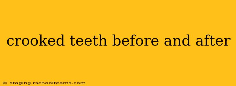crooked teeth before and after