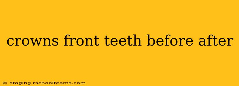 crowns front teeth before after
