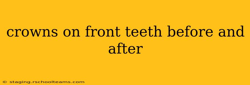 crowns on front teeth before and after