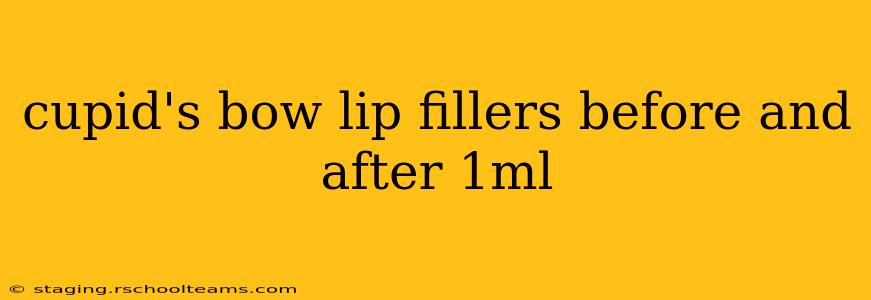 cupid's bow lip fillers before and after 1ml