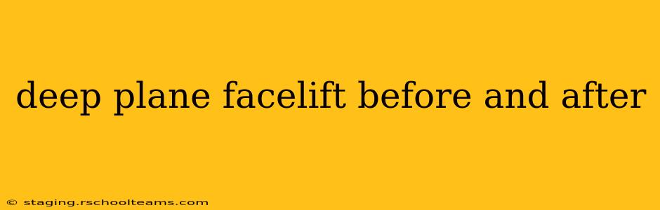 deep plane facelift before and after