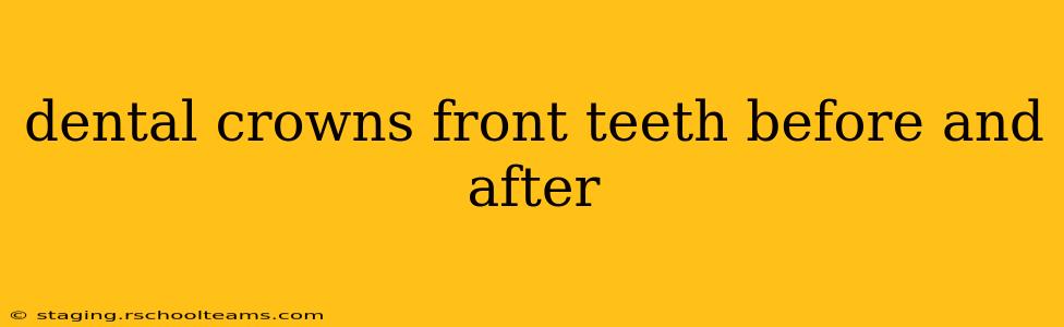 dental crowns front teeth before and after