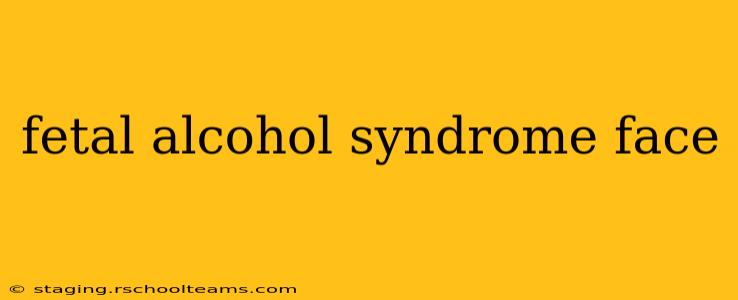 fetal alcohol syndrome face