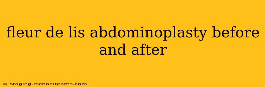 fleur de lis abdominoplasty before and after