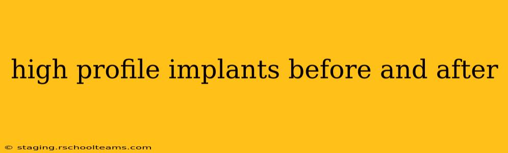 high profile implants before and after