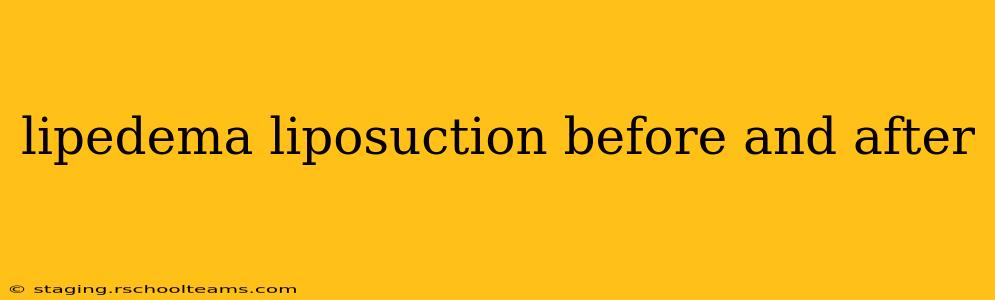 lipedema liposuction before and after
