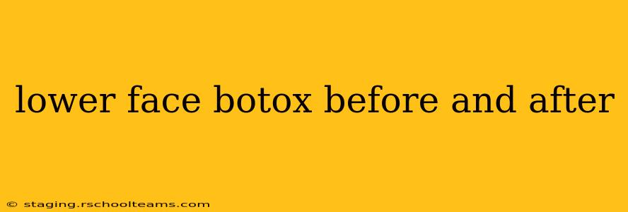 lower face botox before and after