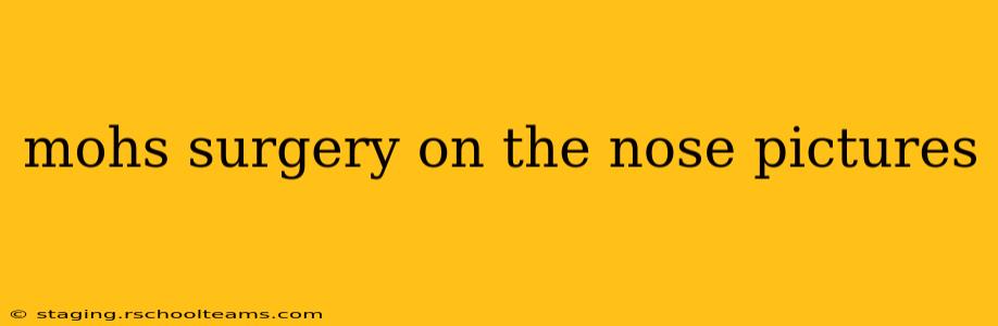 mohs surgery on the nose pictures