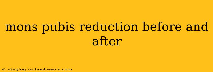 mons pubis reduction before and after