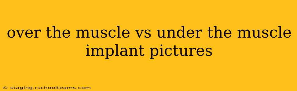 over the muscle vs under the muscle implant pictures