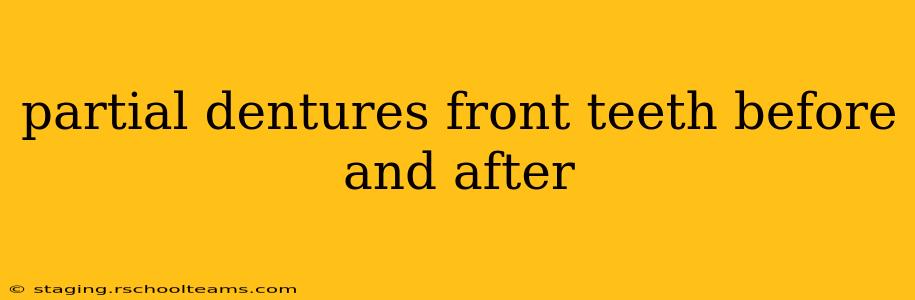 partial dentures front teeth before and after