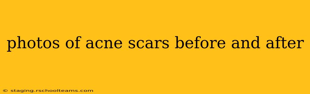 photos of acne scars before and after