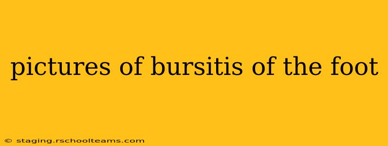pictures of bursitis of the foot