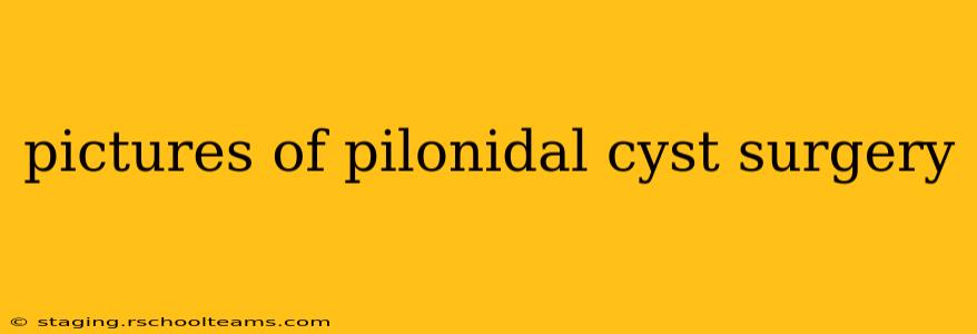 pictures of pilonidal cyst surgery