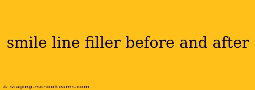smile line filler before and after