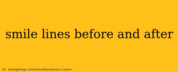 smile lines before and after