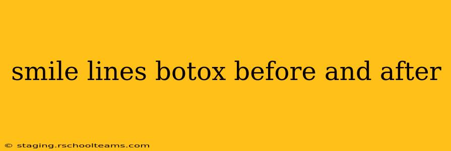 smile lines botox before and after
