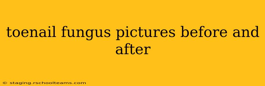 toenail fungus pictures before and after