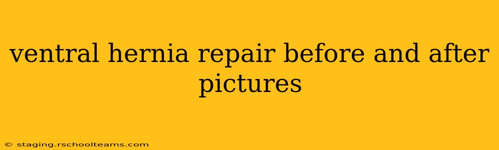 ventral hernia repair before and after pictures