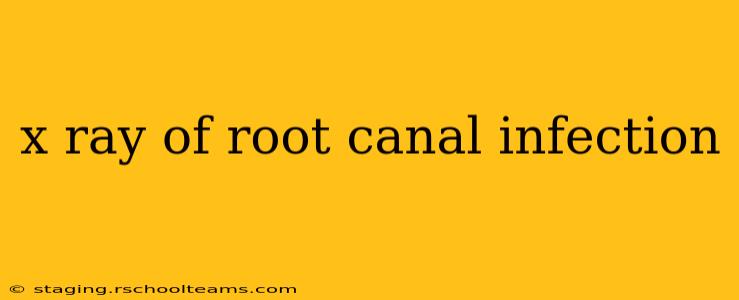 x ray of root canal infection